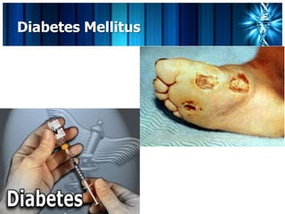 Diabetes Mellitus
 
