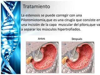 Tratamiento
La estenosis se puede corregir con una
Piloromiotomia,que es una cirugía que consiste en
una incisión de la capa muscular del piloro,que va
a separar los músculos hipertrofiados.
 