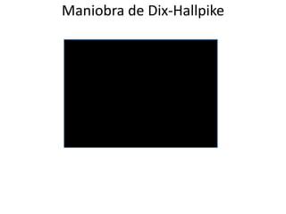 Maniobra de Dix-Hallpike
 