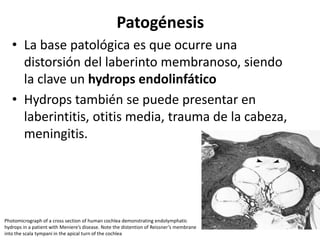 Patogénesis
• La base patológica es que ocurre una
distorsión del laberinto membranoso, siendo
la clave un hydrops endolinfático
• Hydrops también se puede presentar en
laberintitis, otitis media, trauma de la cabeza,
meningitis.
Photomicrograph of a cross section of human cochlea demonstrating endolymphatic
hydrops in a patient with Meniere’s disease. Note the distention of Reissner’s membrane
into the scala tympani in the apical turn of the cochlea
 