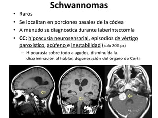 Schwannomas
• Raros
• Se localizan en porciones basales de la cóclea
• A menudo se diagnostica durante laberintectomía
• CC: hipoacusia neurosensorial, episodios de vértigo
paroxistico, acúfeno e inestabilidad (solo 20% px)
– Hipoacusia sobre todo a agudos, disminuída la
discriminación al hablar, degeneración del órgano de Corti
 