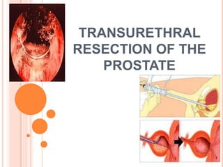 TRANSURETHRAL
RESECTION OF THE
    PROSTATE
 