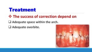Treatment
 The success of correction depend on
 Adequate space within the arch.
 Adequate overbite.
 