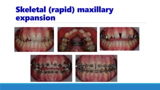 Skeletal (rapid) maxillary
expansion
 