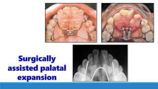 Surgically
assisted palatal
expansion
 