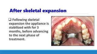 After skeletal expansion
 Following skeletal
expansion the appliance is
stabilized with for 3
months, before advancing
to the next phase of
treatment.
 