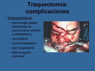 Traqueotomía: complicaciones Intraoperatoria : hemorragia (lesión inadvertida de comunicante anterior o pretiroideos) neumotórax  neumomediastino paro respiratorio edema agudo pulmonar 