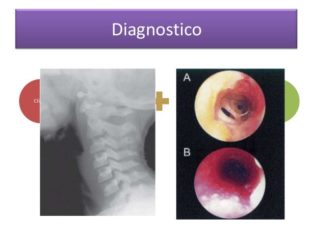 Resultado de imagen para traqueitis