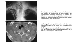 En el traqueocele adquirido, los traumas, las lesiones por
alta presión, la traqueotomía de larga duración, las
enfermedades traqueales obstructivas y, además las
infecciones recurrentes de las glándulas mucosas de la
tráquea con posterior obstrucción y dilatación ductal pueden
desempeñar un papel en la etiología.
A: Radiografía anteroposterior de tórax. Se observa un
saco lleno de aire que se origina en la tráquea proximal
derecha.
B: Tomografía computarizada. Se aprecia un traqueocele
que se origina en el aspecto posterolateral derecho de la
tráquea al nivel del primer anillo traqueal.
 