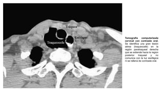 Tomografía computarizada
cervical con contraste oral.
Se identifica una gran lesión
aérea (traqueocele) en la
región paratraqueal derecha
que se extiende hacia la region
posterior traqueal y no
comunica con la luz esofágica
ni se rellena de contraste oral.
 