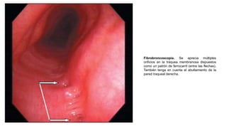 Fibrobroncoscopia. Se aprecia múltiples
orificios en la tráquea membranosa dispuestos
como un patrón de ferrocarril (entre las flechas).
También tenga en cuenta el abultamiento de la
pared traqueal derecha.
 