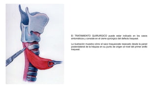 El TRATAMIENTO QUIRURGICO puede estar indicado en los casos
sintomáticos y consiste en el cierre quirúrgico del defecto traqueal.
La ilustración muestra cómo el saco traqueocele resecado desde la pared
posterolateral de la tráquea en su punto de origen al nivel del primer anillo
traqueal.
 