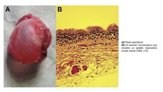 (A) Pieza operatoria.
(B) El examen microscópico que
muestra un epitelio respiratorio
simple ciliado (H&E; x10).
 