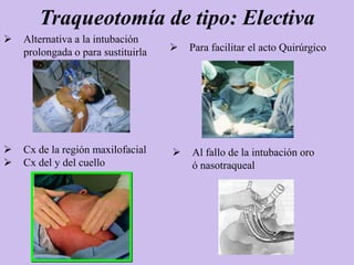 Traqueotomía de tipo: Electiva
   Alternativa a la intubación
    prolongada o para sustituirla      Para facilitar el acto Quirúrgico




   Cx de la región maxilofacial       Al fallo de la intubación oro
   Cx del y del cuello                 ó nasotraqueal
 