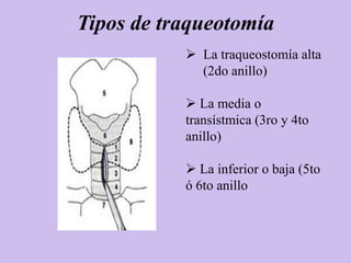 Tipos de traqueotomía
            La traqueostomía alta
             (2do anillo)

            La media o
           transístmica (3ro y 4to
           anillo)

            La inferior o baja (5to
           ó 6to anillo
 