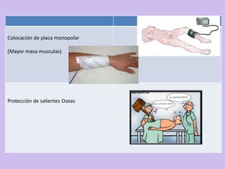 Colocación de placa monopolar

(Mayor masa musculas)




Protección de salientes Oseas
 