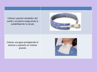 Colocar sujeción alrededor del
cuello y anudarla asegurando la
    estabilidad de la cánula




Colocar una gasa protegiendo el
 estoma y sujetarlo sin realizar
            presión
 