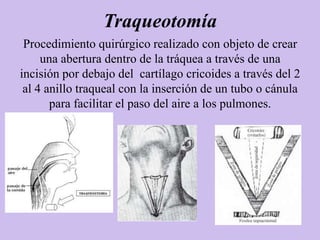Traqueotomía
 Procedimiento quirúrgico realizado con objeto de crear
     una abertura dentro de la tráquea a través de una
incisión por debajo del cartílago cricoides a través del 2
 al 4 anillo traqueal con la inserción de un tubo o cánula
       para facilitar el paso del aire a los pulmones.
 