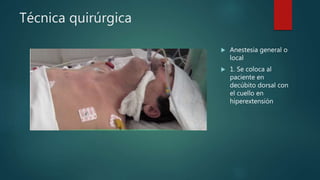 Técnica quirúrgica
 Anestesia general o
local
 1. Se coloca al
paciente en
decúbito dorsal con
el cuello en
hiperextensión
 