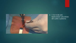  3. Se incide piel,
tejidocelular subcutáneo
del cuello o platisma
 