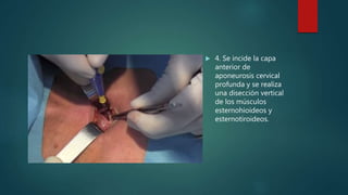  4. Se incide la capa
anterior de
aponeurosis cervical
profunda y se realiza
una disección vertical
de los músculos
esternohioideos y
esternotiroideos.
 