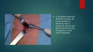  5. Se realiza retracción
del istmo tiroideo, de
no ser posible se
secciona y liga o
sutura, de manera que
permita el fácil acceso
al segundo y tercer
anillo traqueales.
 