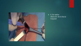  6. Se realiza
disección de la fascia
traqueal
 