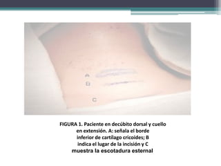 FIGURA 1. Paciente en decúbito dorsal y cuello
en extensión. A: señala el borde
inferior de cartílago cricoides; B
indica el lugar de la incisión y C
muestra la escotadura esternal
 