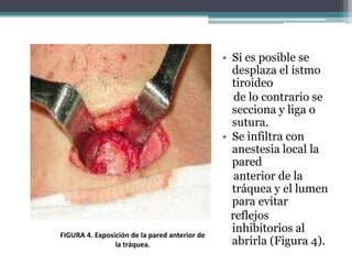 • Si es posible se
desplaza el istmo
tiroideo
de lo contrario se
secciona y liga o
sutura.
• Se infiltra con
anestesia local la
pared
anterior de la
tráquea y el lumen
para evitar
reflejos
inhibitorios al
abrirla (Figura 4).
FIGURA 4. Exposición de la pared anterior de
la tráquea.
 