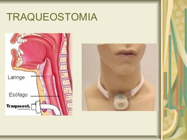 Anatomia Do Procedimento De Traqueostomia Grátis: Procedimento De