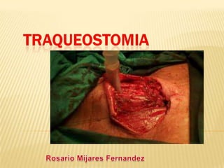 Traqueostomia clinicas de enfermeria 1 v my doc