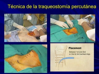 Técnica de la traqueostomía percutáneaTécnica de la traqueostomía percutánea
 