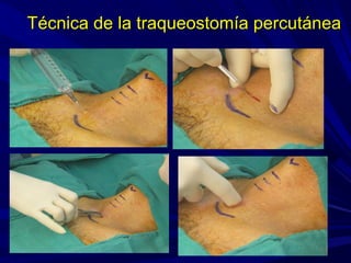 Técnica de la traqueostomía percutáneaTécnica de la traqueostomía percutánea
 
