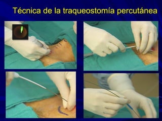 Técnica de la traqueostomía percutáneaTécnica de la traqueostomía percutánea
 