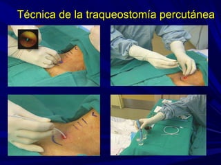 Técnica de la traqueostomía percutáneaTécnica de la traqueostomía percutánea
 