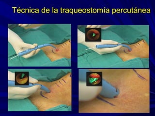Técnica de la traqueostomía percutáneaTécnica de la traqueostomía percutánea
 