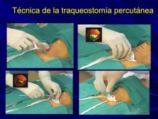 Técnica de la traqueostomía percutáneaTécnica de la traqueostomía percutánea
 