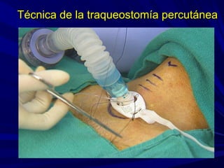 Técnica de la traqueostomía percutáneaTécnica de la traqueostomía percutánea
 