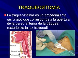 TRAQUEOSTOMIATRAQUEOSTOMIA
La traqueostomía es un procedimiento
quirúrgico que corresponde a la abertura
de la pared anterior de la tráquea
(exterioriza la luz traqueal)
 