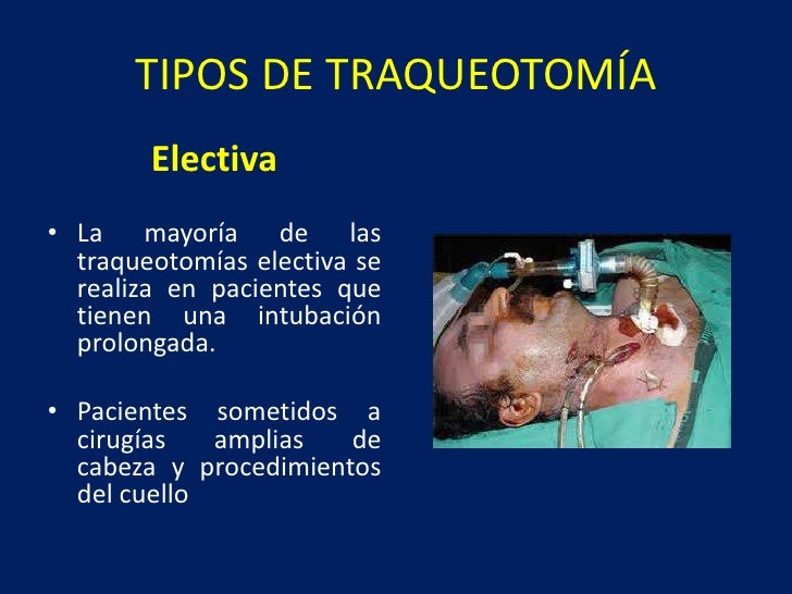Traqueotomia