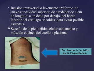 • Incisión transversal o levemente arciforme de
Incisión transversal o levemente arciforme de
suave concavidad superior, de alrededor de 4 cm
suave concavidad superior, de alrededor de 4 cm
de longitud, a un dedo por debajo del borde
de longitud, a un dedo por debajo del borde
inferior del cartílago cricoides para evitar posible
inferior del cartílago cricoides para evitar posible
estenosis.
estenosis.
 Sección de la piel, tejido celular subcutáneo y
Sección de la piel, tejido celular subcutáneo y
músculo cutáneo del cuello o platisma.
músculo cutáneo del cuello o platisma.
Se observa la incisió n
de la traqueotomía.
 