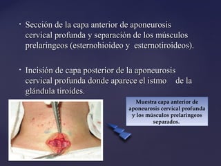 • Sección de la capa anterior de aponeurosis
Sección de la capa anterior de aponeurosis
cervical profunda y separación de los músculos
cervical profunda y separación de los músculos
prelaringeos (esternohioideo y esternotiroideos).
prelaringeos (esternohioideo y esternotiroideos).
• Incisión de capa posterior de la aponeurosis
Incisión de capa posterior de la aponeurosis
cervical profunda donde aparece el istmo
cervical profunda donde aparece el istmo de la
de la
glándula tiroides.
glándula tiroides.
Muestra capa anterior de
aponeurosis cervical profunda
y los músculos prelaringeos
separados.
Muestra capa anterior de
aponeurosis cervical profunda
y los músculos prelaringeos
separados.
 