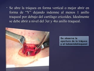 • Se abre la tráquea en forma vertical o mejor abrir en
Se abre la tráquea en forma vertical o mejor abrir en
forma de “Y” dejando indemne al menos 1 anillo
forma de “Y” dejando indemne al menos 1 anillo
traqueal por debajo del cartílago cricoides. Idealmente
traqueal por debajo del cartílago cricoides. Idealmente
se debe abrir a nivel del 3er y 4to anillo traqueal.
se debe abrir a nivel del 3er y 4to anillo traqueal.
Se observa la
apertura de la tráquea
y el tuboendotraqueal
 