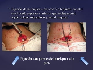 • Fijación de la tráquea a piel con 5 o 6 puntos en total
Fijación de la tráquea a piel con 5 o 6 puntos en total
en el borde superior e inferior que incluyan piel,
en el borde superior e inferior que incluyan piel,
tejido celular subcutáneo y pared traqueal.
tejido celular subcutáneo y pared traqueal.
Fijación con puntos de la tráquea a la
piel.
 