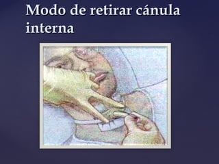 Modo de retirar cánula
Modo de retirar cánula
interna
interna
 