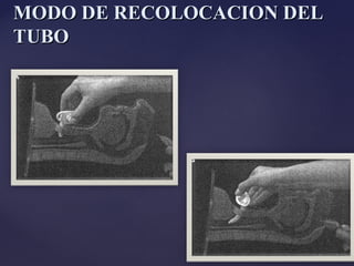 MODO DE RECOLOCACION DEL
MODO DE RECOLOCACION DEL
TUBO
TUBO
 