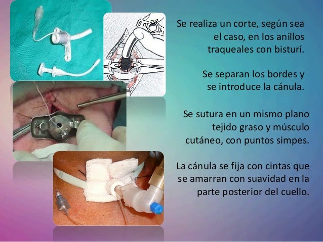Traqueotomia