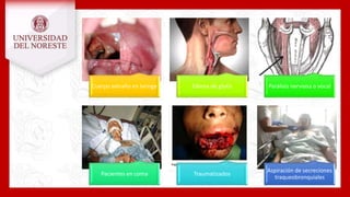 Cuerpo extraño en laringe Edema de glotis Parálisis nerviosa o vocal
Pacientes en coma Traumatizados
Aspiración de secreciones
traqueobronquiales
 