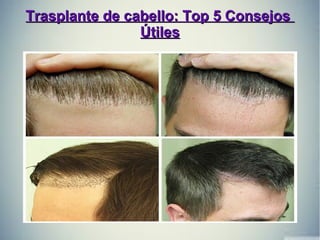 Trasplante de cabello: Top 5 ConsejosTrasplante de cabello: Top 5 Consejos
ÚtilesÚtiles
 