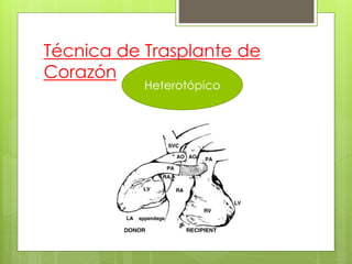 Técnica de Trasplante de
Corazón
Heterotópico
 